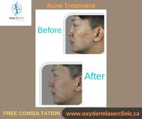 Acne treatment, Acne treatment in Edmonton | Oxyderm Laser Clinic