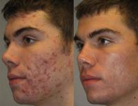 Laser Clinic for Skin Treatment  in Alberta | Acne treatment clinic in Edmonton | Oxyderm Cinic